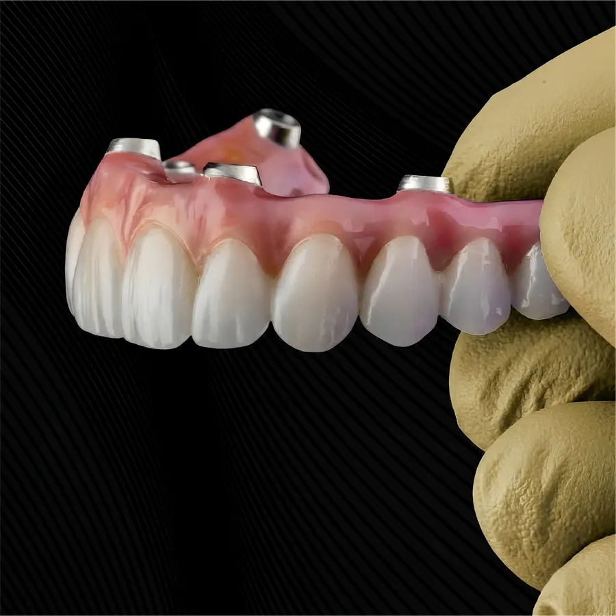All-on-X náhrada chrupu na implantátoch